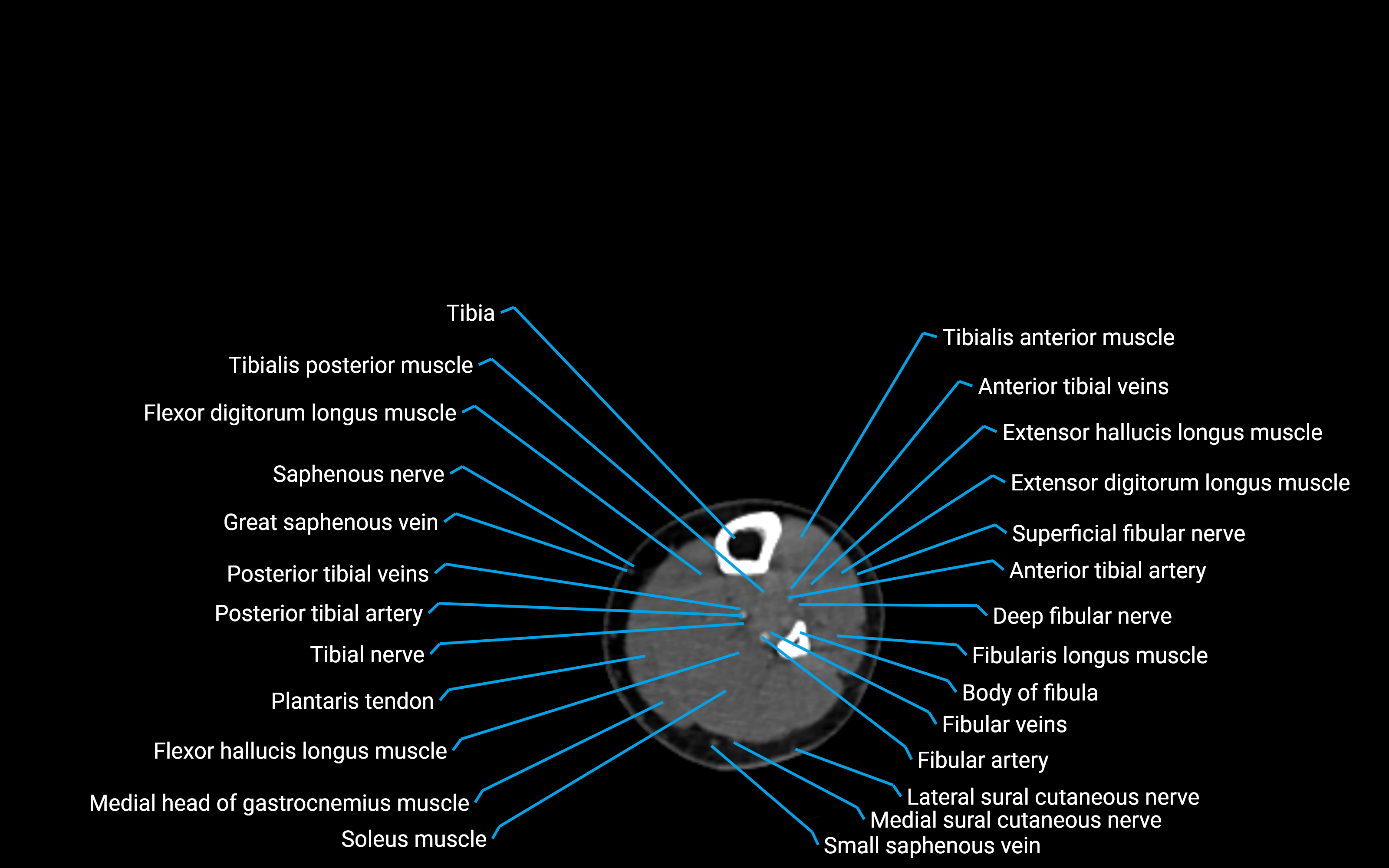 CT Lower leg axial cross sectional anatomy labelled image 119 (2).png